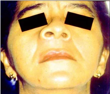 Figura 1.  Tumoração na região da asa nasal direita.