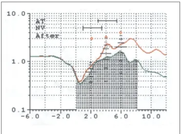 Figura 1. Rinograma nasal após vasoconstritor antes (inferior) e depois (superior) da cirurgia de adenoidectomia