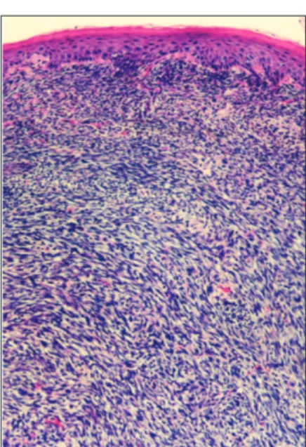 Figura 1. Proliferação fibrossarcomatosa em mucosa escamosa subepitelial. Coloração de HE 100x.
