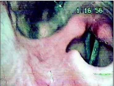 Figura 2. Laringoscopia pós-operatória, com fechamento glótico satisfatório.