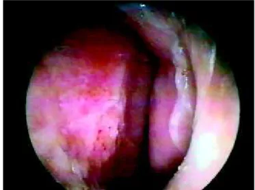 Foto 1. Estomatite moriforme em palato. Foto 2. Acometimento septal de fossa nasal esquerda.