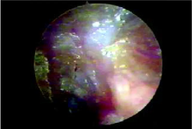 Figura 6. Otoendoscopia de paciente ouvido com 10 dias de pós operatório, mostrando perfuração fechada (apenas com o uso da membrana) e membrana de látex.