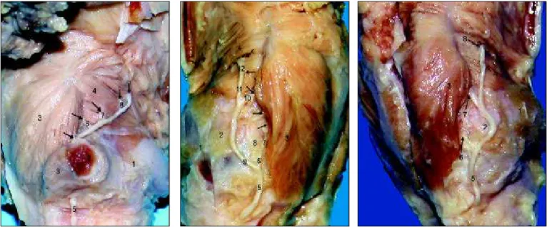 Figura 3. Vista posterolateral direita da laringe: 1. Cartilagem cricóide; 2. Face articular tireóidea da cartilagem cricóide; 3.