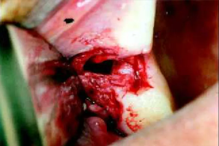 Figura 3a: Aspecto clínico da fístula. Figura 3b: Incisão vestibular e deslocamento da fistula