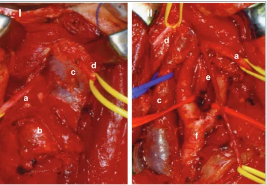 Figura 4. Tumor de corpo carotídeo: antes (I) e após a ressecção cirúrgica (II). a) nervo hipoglosso, b) tumor de corpo carotídeo, c) veia jugular interna,  d)  nervo  acessório,  e)  ramo  descendente  do  nervo  hipoglosso, f)  bifurcação  carotídea.