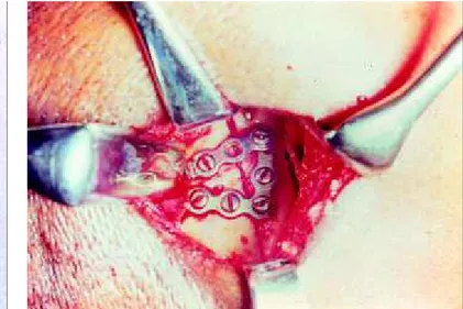 Figura 3-a. Demarcação da osteotomia vertical d o ramo med iante acesso submandibular para facilitar a  locali-zação do côndilo e posterior redução e fixação interna rígida.