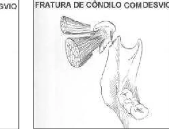 Figura 11-a. Fratura sem luxação do côndilo e sem desvio (tratamento conservador).