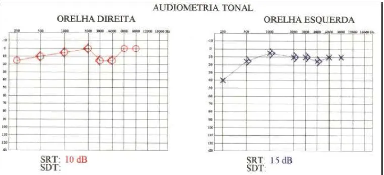 Figura 1a. audiometria tonal realizada durante a crise vertiginosa mostrando perda auditiva em freqüências graves com curva ascendente em orelha esquerda