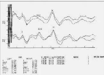 Figura 2. OEA-T em orelha esquerda e direita, mostrando baixa resposta em 7,5 dB em orelha direta e 5,8 dB em orelha esquerda.