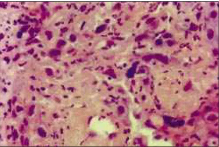Foto 3.  Preparação histológica de carcinoma epidermóide invasivo evidenciando focos de necrose  HE
