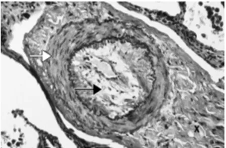 Figura 1 - Artéria muscular pulmonar de um doente com HPA com hipertrofia muscular (seta  branca)  e  estreitamento  luminal  devido  a  proliferação  da  camada  intima  (seta  preta)  (adaptado de Gaine 1998)