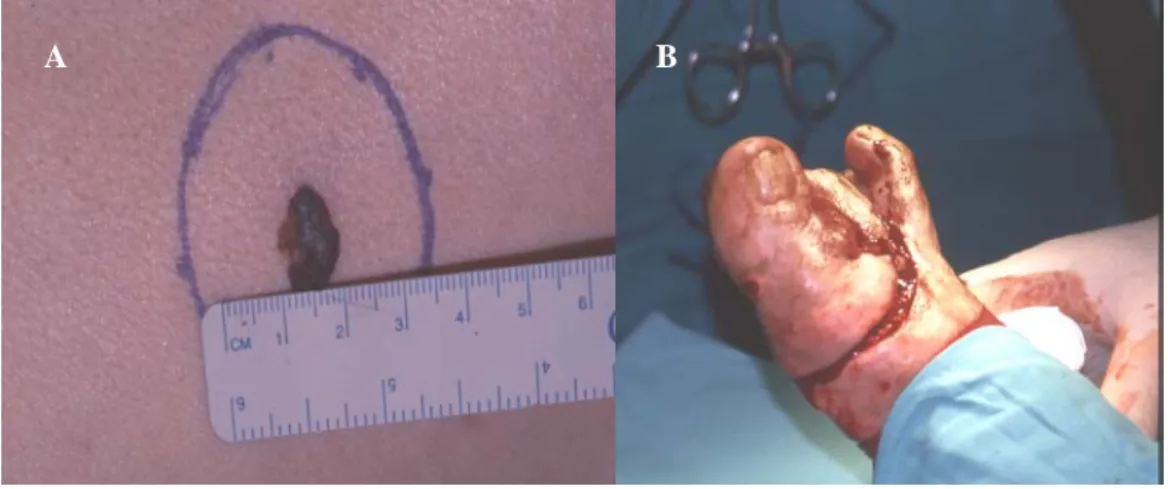 Figura 4 - A. Margens cirúrgicas de 1,5 cm de melanoma de extensão superficial - índice de  Breslow 2 mm e nível de Clark III