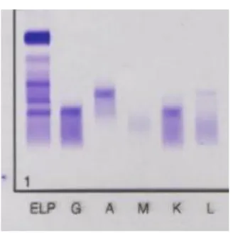 Figura 7. Imunofixação sérica evidenciando um pico biclonal: IgG kappa e IgA kappa. 