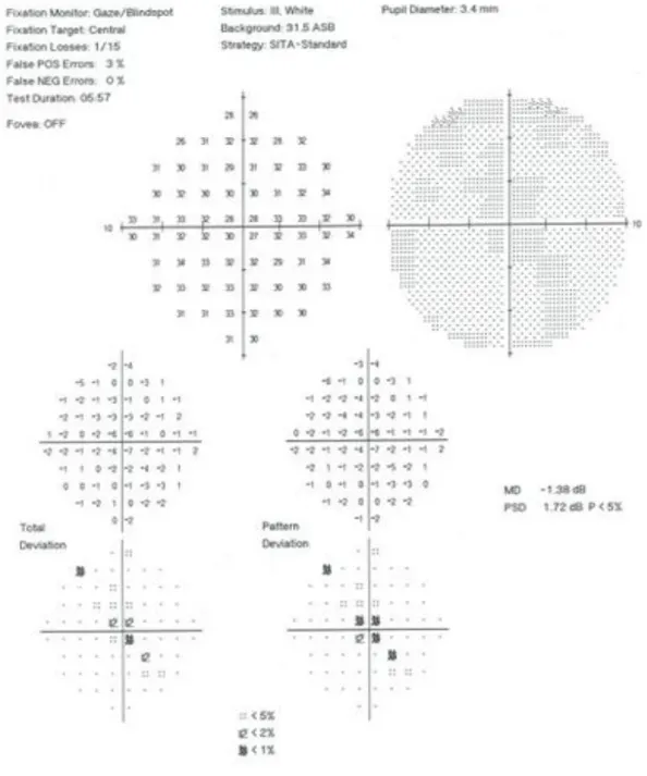 Figura  2  –  Campimetria  no  perimetro  de  Humphrey  do  OD  da  paciente.  Apresenta  os  mapas  probabilísticos  de  Desvio  Total  (Total  Deviation)  e  Desvio  da  Forma  (Pattern  Deviation)  assim  como  o  mapa de cinzentos