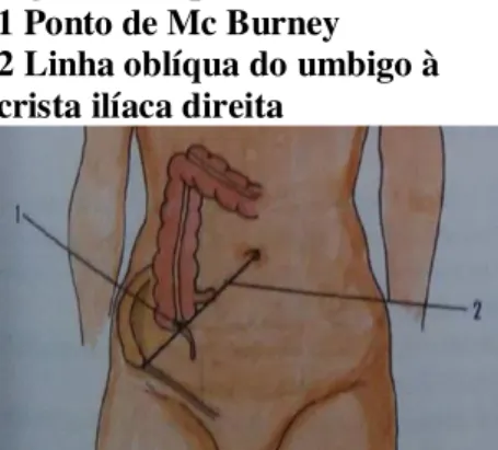 Figura 2.1 Apêndice   1 Ponto de Mc Burney  2 Linha oblíqua do umbigo à  crista ilíaca direita 