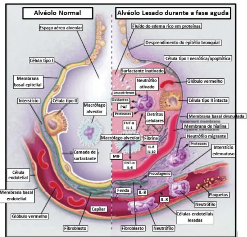 Figura 2.2 – Alvéolos normal (lado esquerdo) e lesado (lado direito) durante a fase aguda  da Síndrome de Dificuldade Respiratória Aguda
