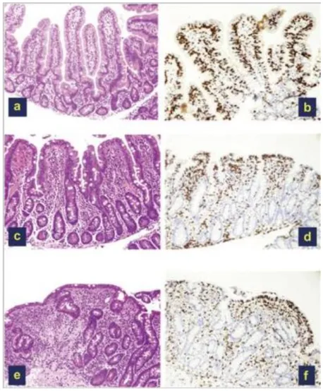 Figura 1 - Diferentes graus de danos no intestino delgado em pacientes com doença celíaca 