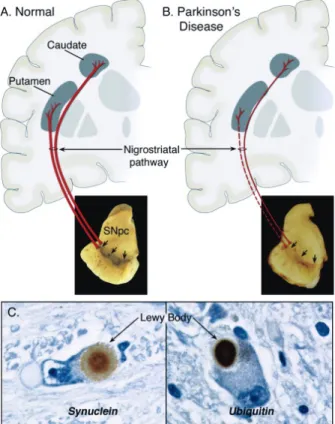 Figure 1: Neuropathology of PD. Schematic representation of the normal (A) and diseased (B)  nigrostriatal pathway
