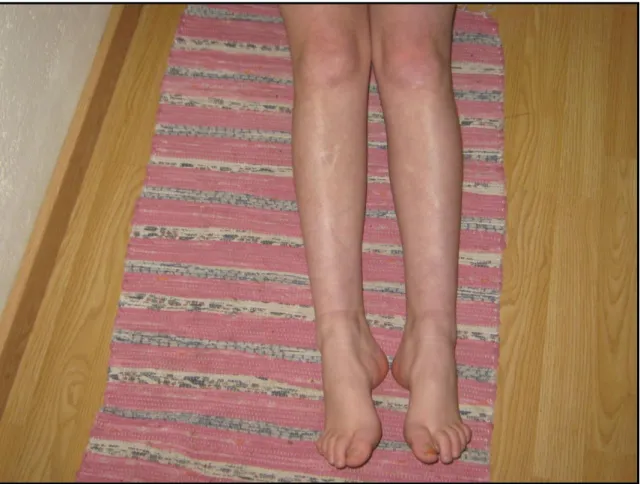 Figura 7: Fotografia de uma doente com ataxia de Friedreich. É possível identificar a existência de pés  cavus