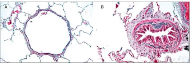 Figura  1  -  Comparação  das  vias  aéreas  respiratórias  de  indivíduos  adultos  saudáveis  (A)  e  indivíduos  adultos com DPOC (B) - estreitamento das vias por infiltração de células inflamatórias, excesso de muco  e deposição de tecido conjuntivo, a