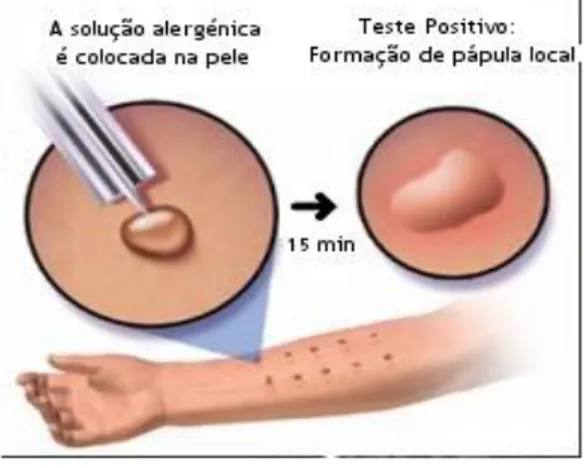 Figura 3.5 – Esquematização do procedimento de aplicação de reagentes de testes cutâneos por picada  no antebraço de um doente alérgico ( http://www.medinik.com/allergy/skin-allergy-test)