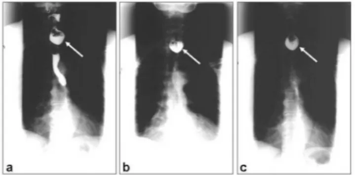 Figura  1.  Radiograias  do  esôfago  da  paciente  número  1,  obtidas  aos dez segundos (a), cinco minutos (b) e aos 30 minutos (c) após a  ingestão do meio de contraste