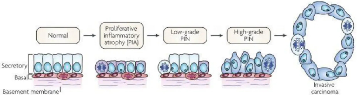 Figure 2: Stages of prostatic cancer (Adapted from (8)). 