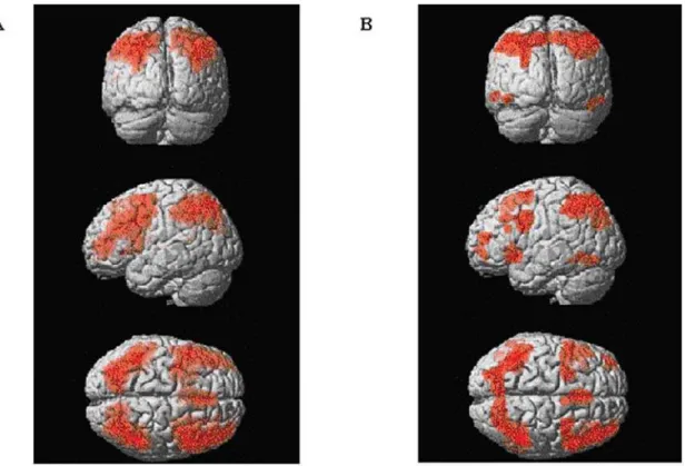 Figura 2 - Ativação cerebral dos controles (A) e pacientes (B) durante o N-Back Task (Análise de catego- catego-rias).