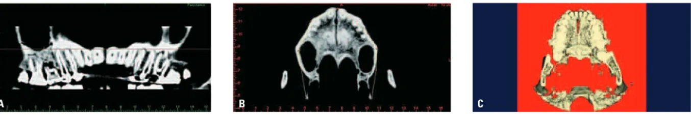 FIGURA 1 - Imagens obtidas por meio do iCAT TM  3-D Dental Imaging System após a expansão da maxila