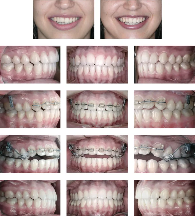 FIGURA 7 - Caso clínico 2. Dente 11 anquilosado. Tratamento realizado por meio de intrusão de todos os dentes superiores, com exceção do dente 11.