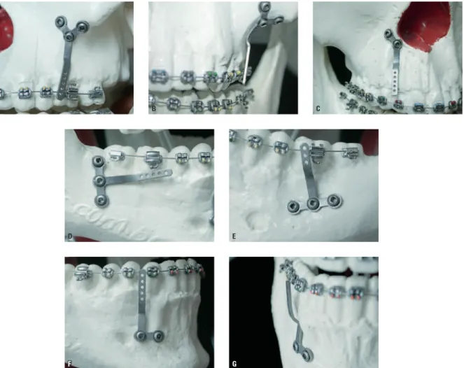 FIGURA 4 - Adaptação e posicionamento do SAO ® : A, B) pilar zigomático; C) abertura piriforme; D) ramo mandibular; E) corpo mandibular e F, G) anterior ao forame  mentoniano.A BDF GE C
