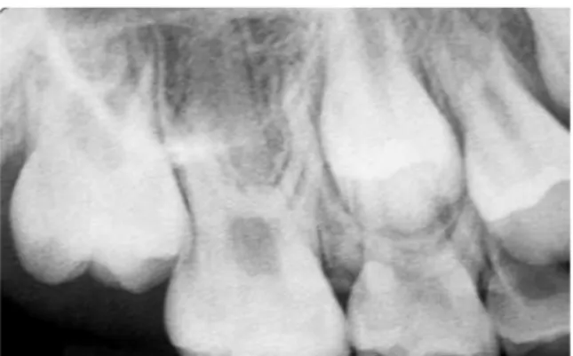 FIGURA 2 - Radiografia periapical da região do primeiro molar permanen- permanen-te, do mesmo caso, ao final do tratamento com o AEB.