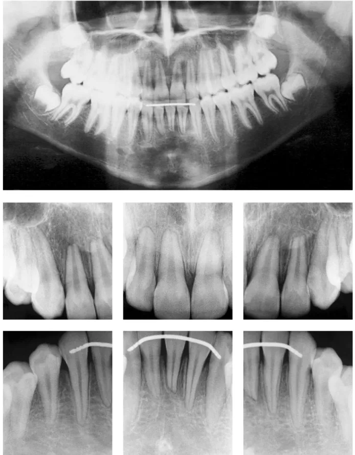 FIGURA 11 - Radiografias panorâmica e periapicais anteriores finais, mostrando as reabsorções já previstas.