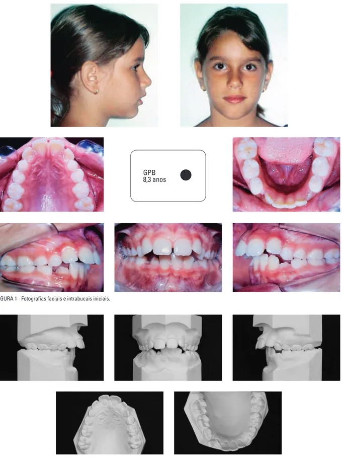 FIGURA 1 - Fotografias faciais e intrabucais iniciais.