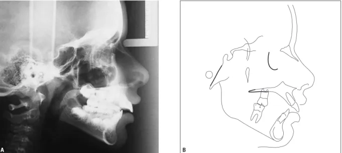 FIGURA 4 - Radiografia cefalométrica de perfil (A) e traçado cefalométrico (B) iniciais.