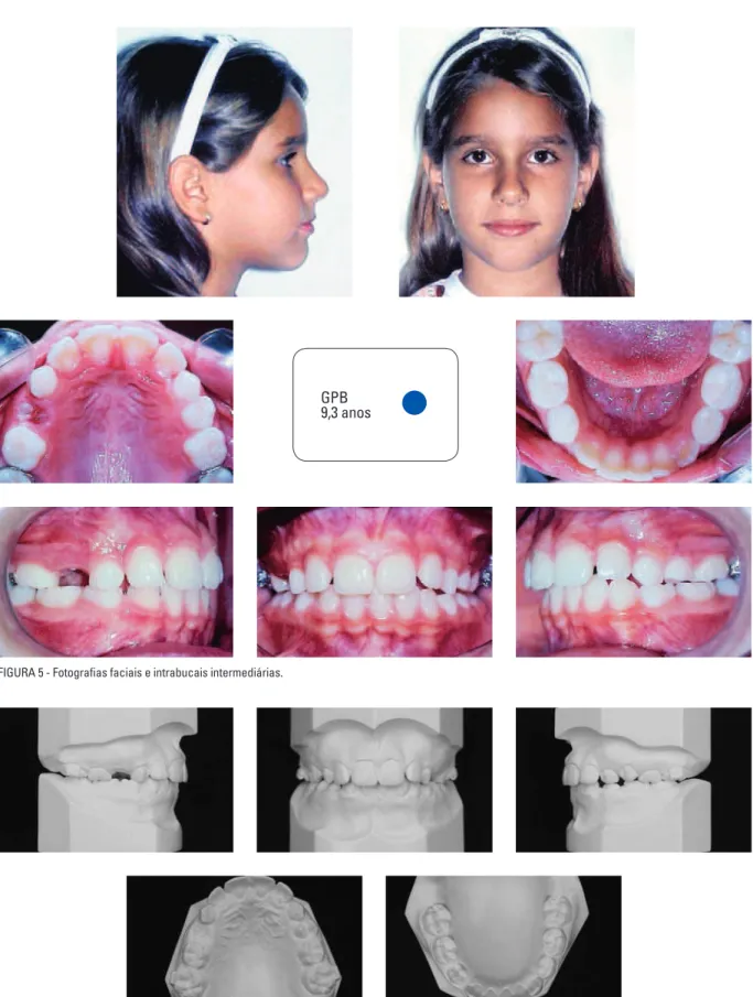 FIGURA 5 - Fotografias faciais e intrabucais intermediárias.