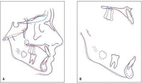 FIGURA  19  -  Sobreposições  total  e  parciais  dos  traçados  cefalométricos  intermediário  (azul)  e  final  (vermelho).
