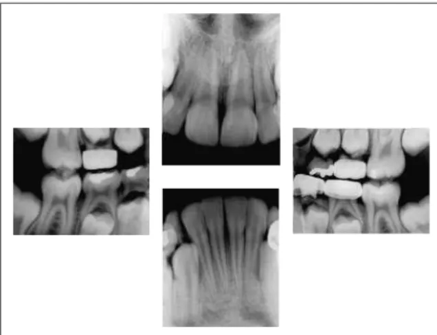 FIGURA 5 - Radiografia de mão e punho inicial.