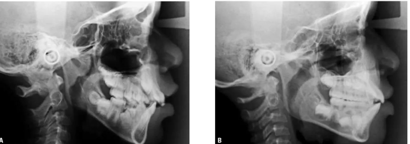 FIGURA 1 - Exemplos de imagens das radiografias cefalométricas de perfil obtidas no estudo: A) paciente portador de hipertrofia de adenoide, B) paciente  sem hipertrofia de adenoide.
