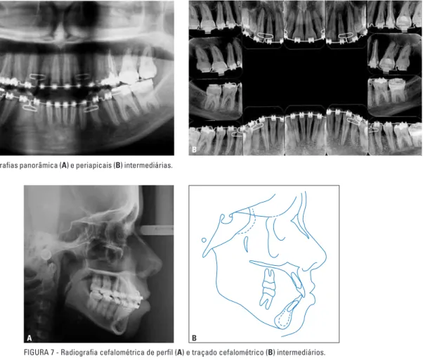 FIGURA 8 - Modelos intermediários, após a exodontia dos primeiros pré-molares superiores e inferiores.