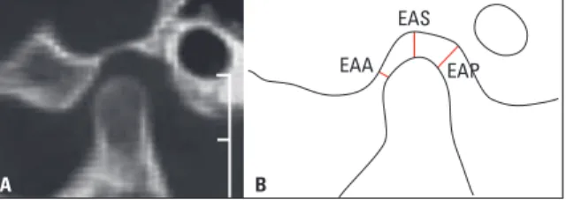FIGURA 3 - A) Fotograia de imagem tomográica sagital e B) desenho  esquemático  das  medidas  do  espaço  articular  anterior  (EAA),  espaço  articular superior (EAS) e espaço articular posterior (EAP).