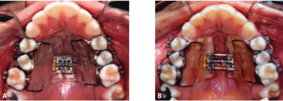 FIGURA 3 - Fotografias intrabucais oclusais superiores mostrando o aspecto clínico transverso:  A ) antes e  B ) após a ERM