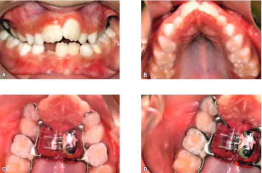 FIGURA 1 - Mordida cruzada posterior (A)  resultante da atresia simétrica do arco dentário superior (B)