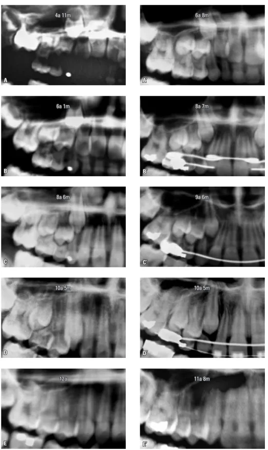 FIGURA 4 - Radiografias panorâmicas de um paciente que se submeteu à ERM (grupo experimental) e um paciente que não se submeteu à ERM (grupo  controle)