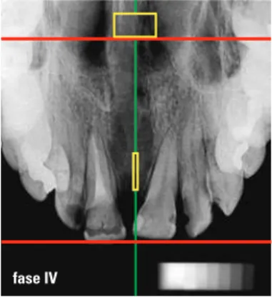 FIGURA 3 - Radiografia oclusal três meses  após o fechamento do parafuso expansor.