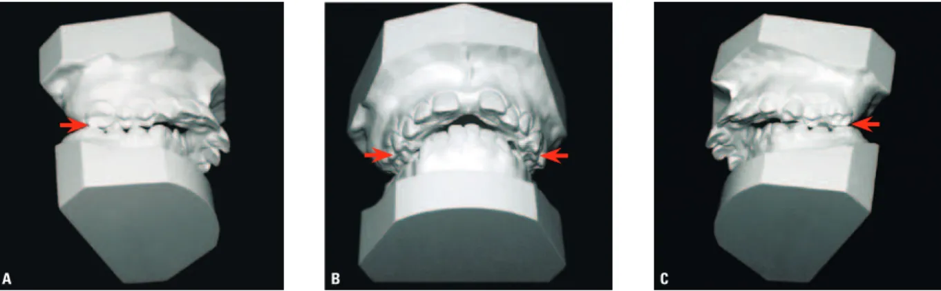 FIGURA 9 - Modelos de estudo de paciente portador de má oclusão de Classe II na fase pós-expansão: observa-se a sobrecorreção e as cúspides linguais  dos dentes posterossuperiores em contato com as cúspides vestibulares dos posteroinferiores (setas).