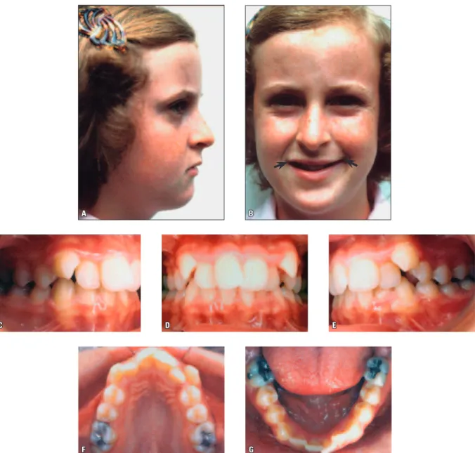 FIGURA 10 - Paciente portadora de má oclusão de Classe II, aos 11 anos e 11 meses de idade na fase pré-tratamento