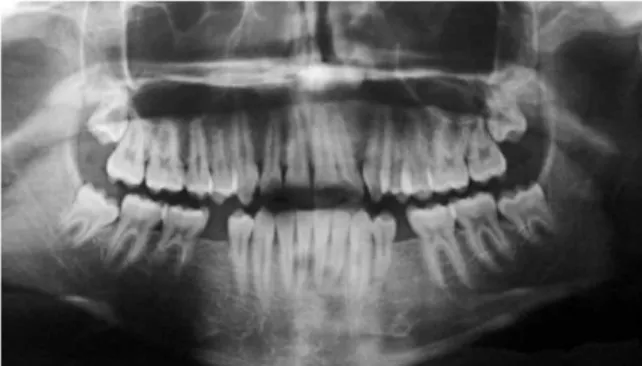 FIGURA 5 - Radiografias periapicais dos dentes anteriores superiores e  inferiores interproximais dos lados direito e esquerdo iniciais.