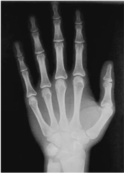 FIGURA 6 - Radiografia de mão e punho inicial.