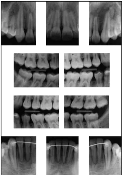 FIGURA 10 - Radiografia panorâmica final. FIGURA 11 - Radiografias periapicais dos den-